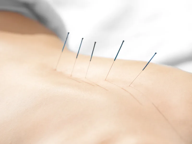 Acupuncture at Integrated Chiropractic in Defiance