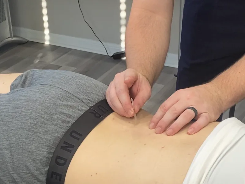 How Dry Needling works at Integrated Chiropractic