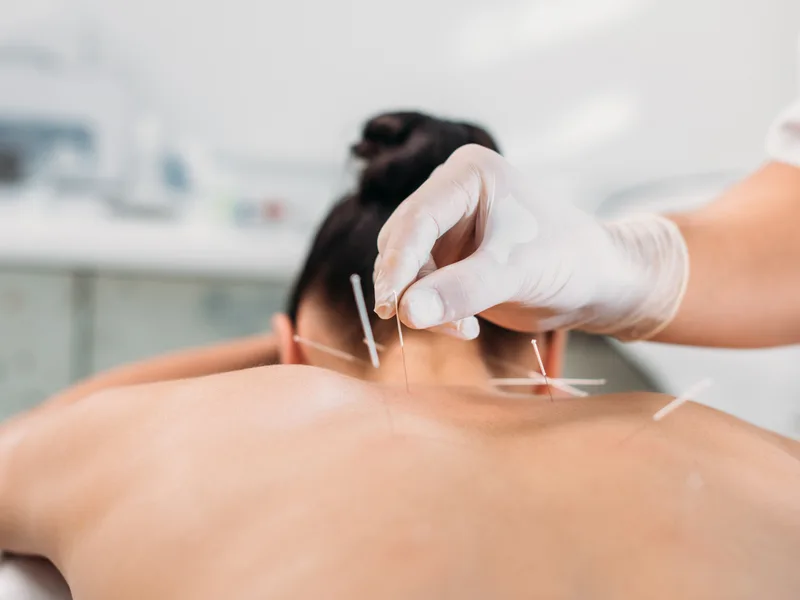 Dry Needling at Integrated Chiropractic in Defiance